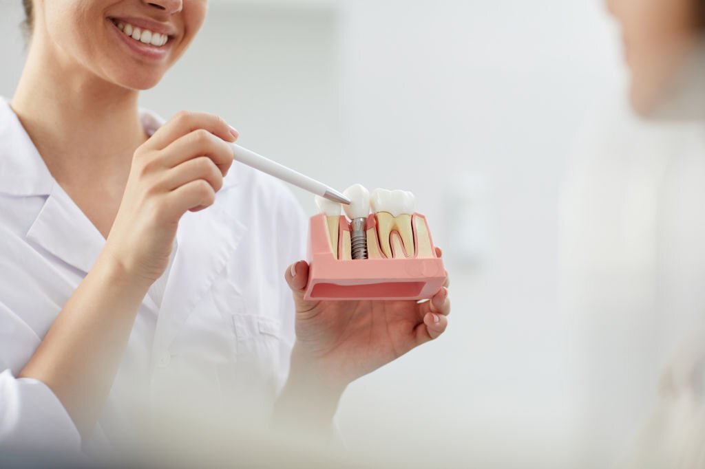 How Do I Find a Dental Implant Specialist?