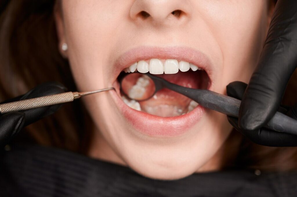 How Much Does a Dental Filling Cost?
