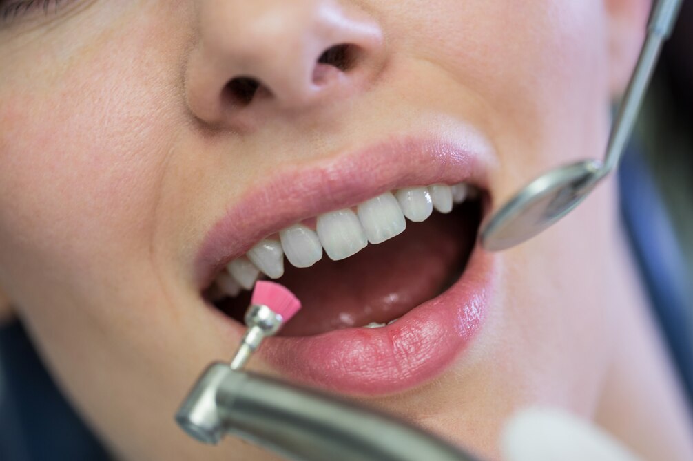 What is the Importance of Teeth Cleaning