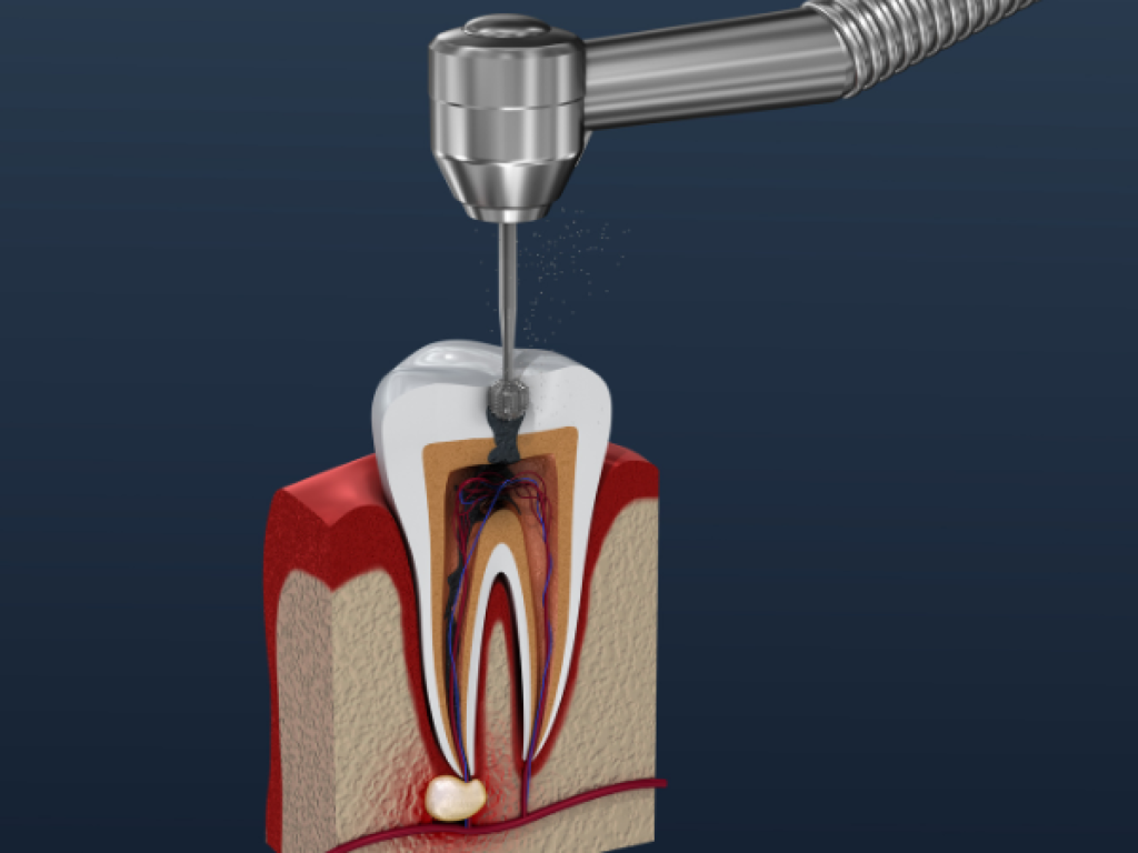 Signs That You Need a Root Canal