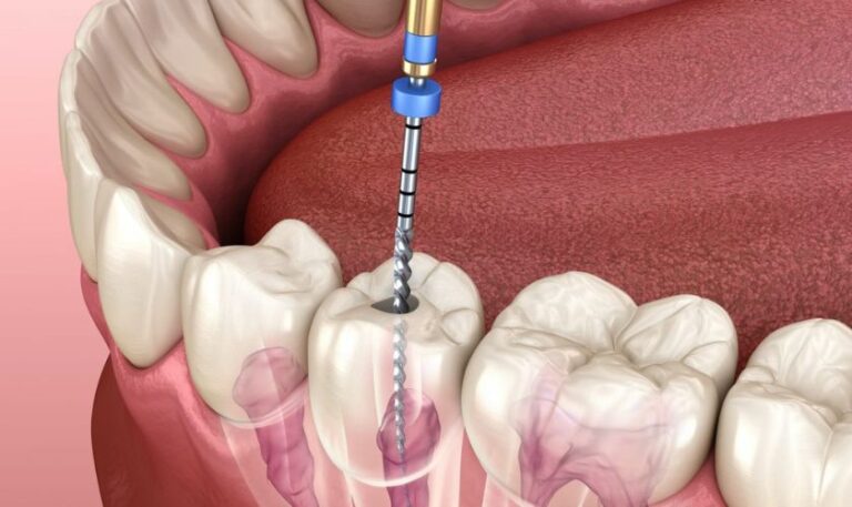 Root Canal Treatment