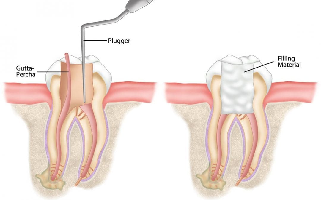 Tooth Extraction vs. Root Canal Treatment