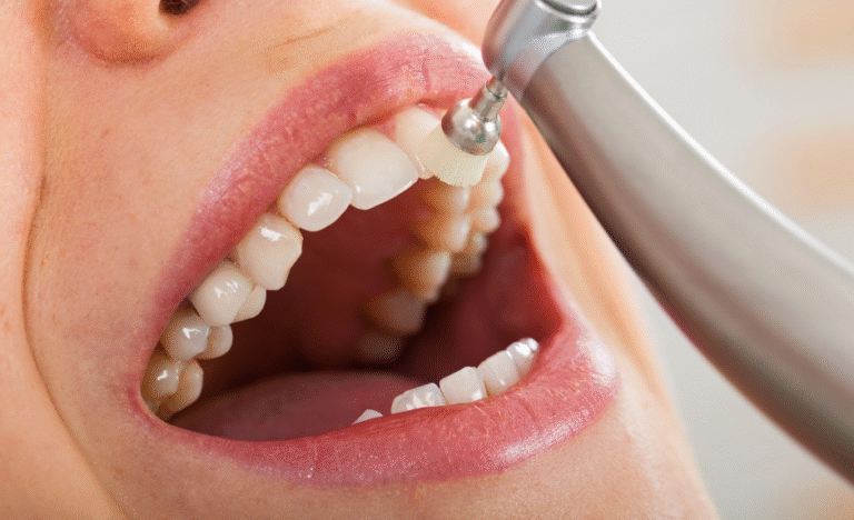 deep teeth cleaning Hammond